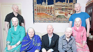 worlds biggest albino family