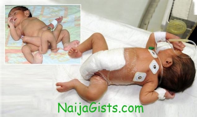 doctors removed four extra limbs from baby born with six legs doctors removed four extra limbs from baby born with six legs