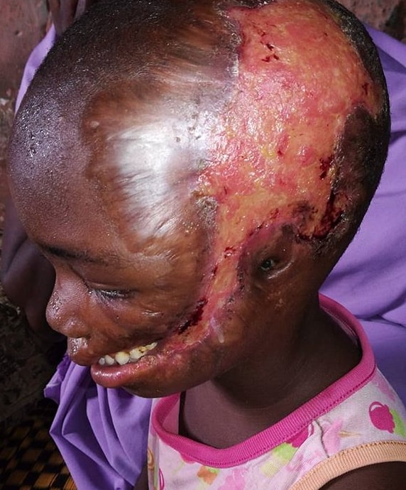 doctors put iv girl head kaduna